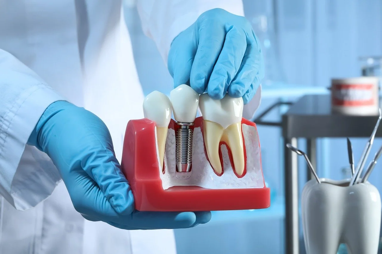 Dental Implants Scotland Comprehensive Guide